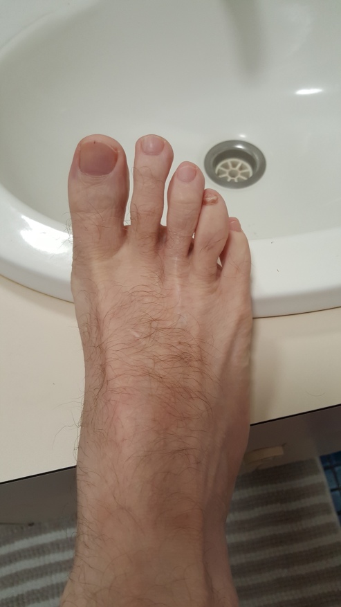 Foot pre surgery